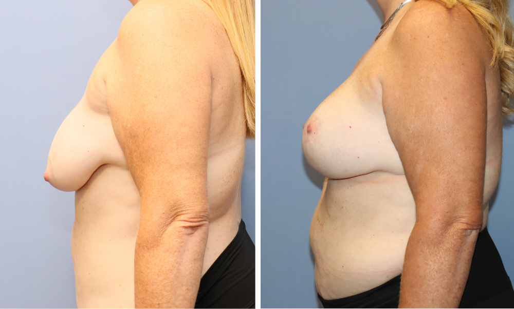 Before and after side profile showing breast augmentation results
