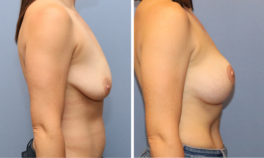 Before and after side profile of breast augmentation results
