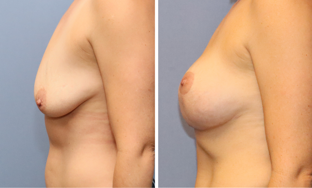 Before and after side view of breast augmentation results