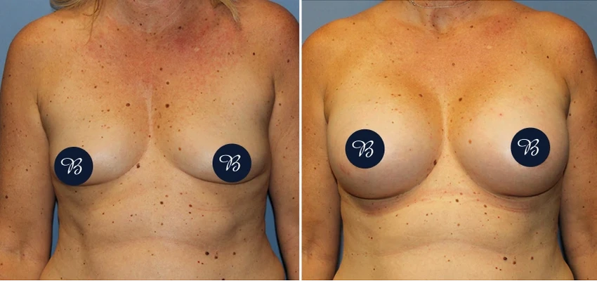 Before and after breast augmentation showing increased volume and improved proportions