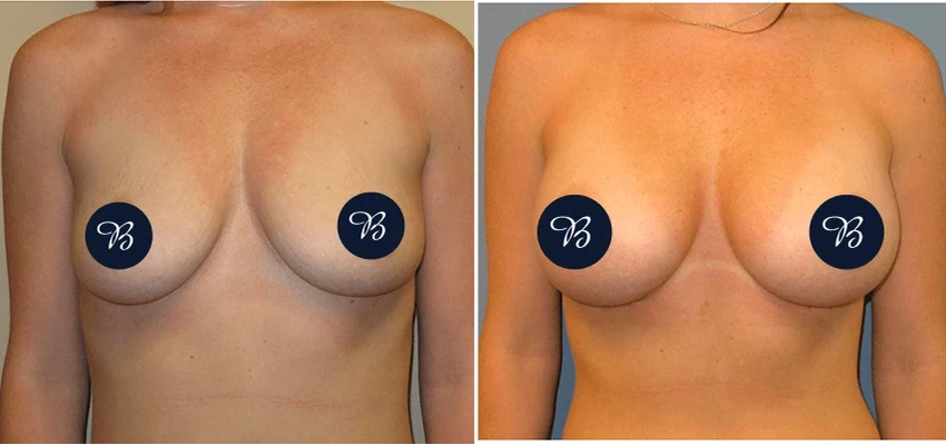 Before and after breast augmentation, showing increased volume and improved symmetry