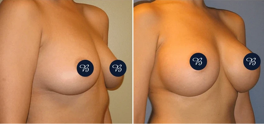 Before and after breast augmentation, showing enhanced size and improved shape