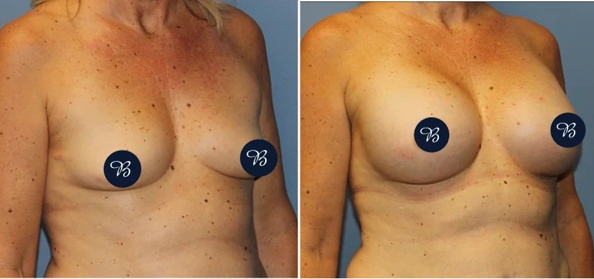 Before and after breast augmentation showing increased volume and improved symmetry
