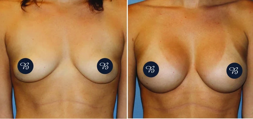 Before and after breast augmentation showing enhanced volume and improved shape