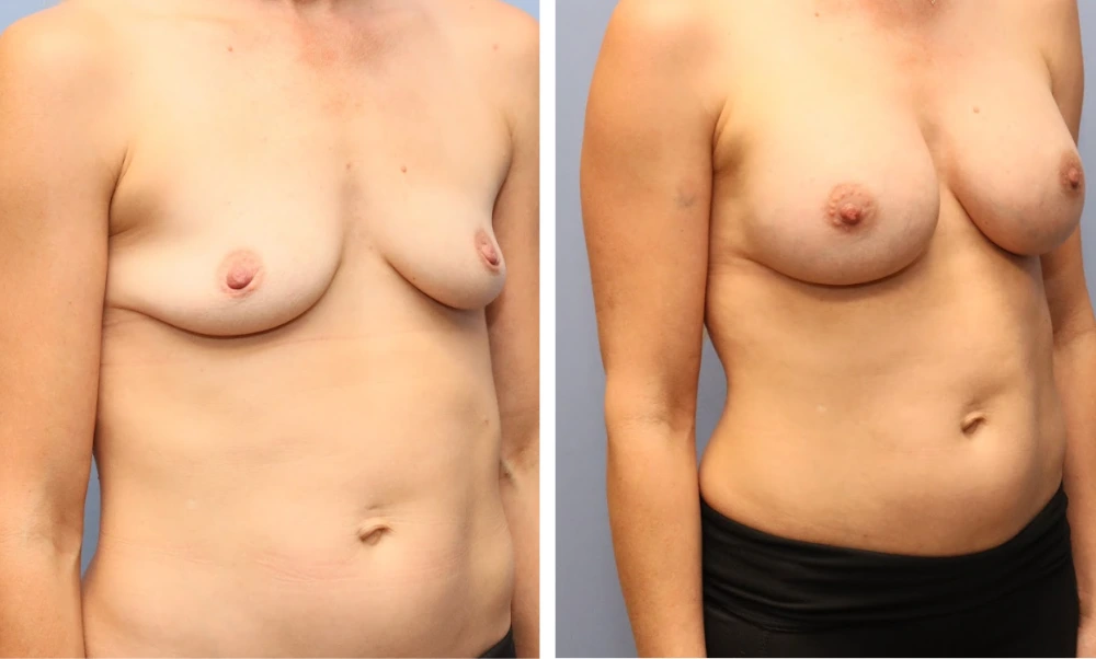 Breast augmentation before and after comparison showing frontal-angled view