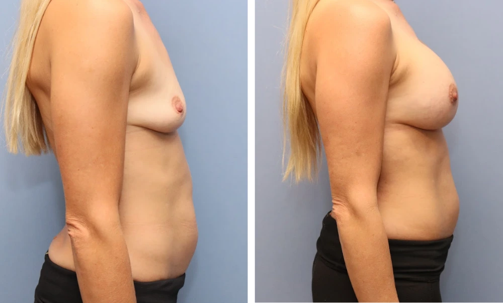 Breast augmentation before and after comparison showing side profile view