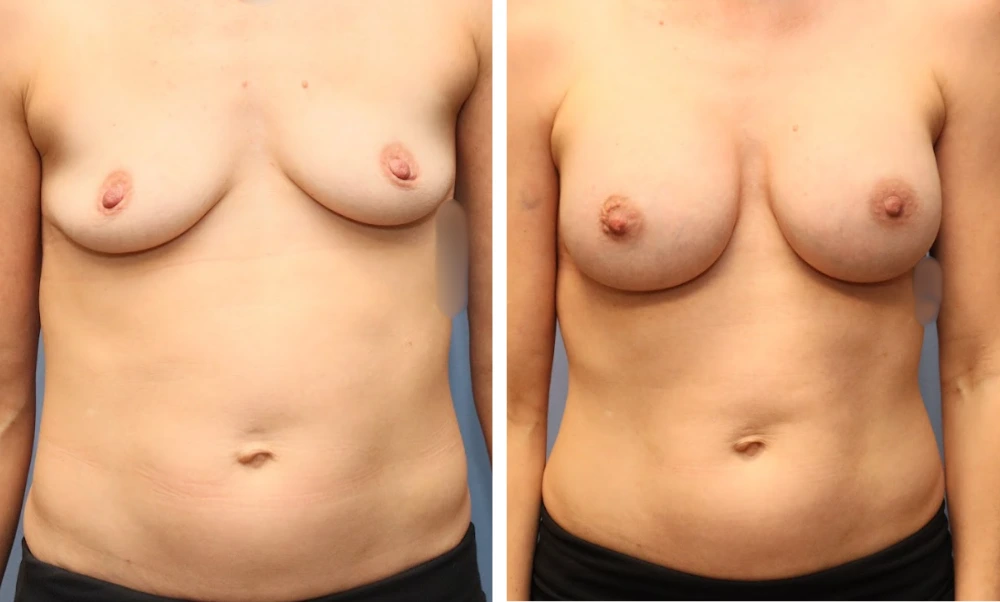 Breast augmentation before and after comparison showing frontal view