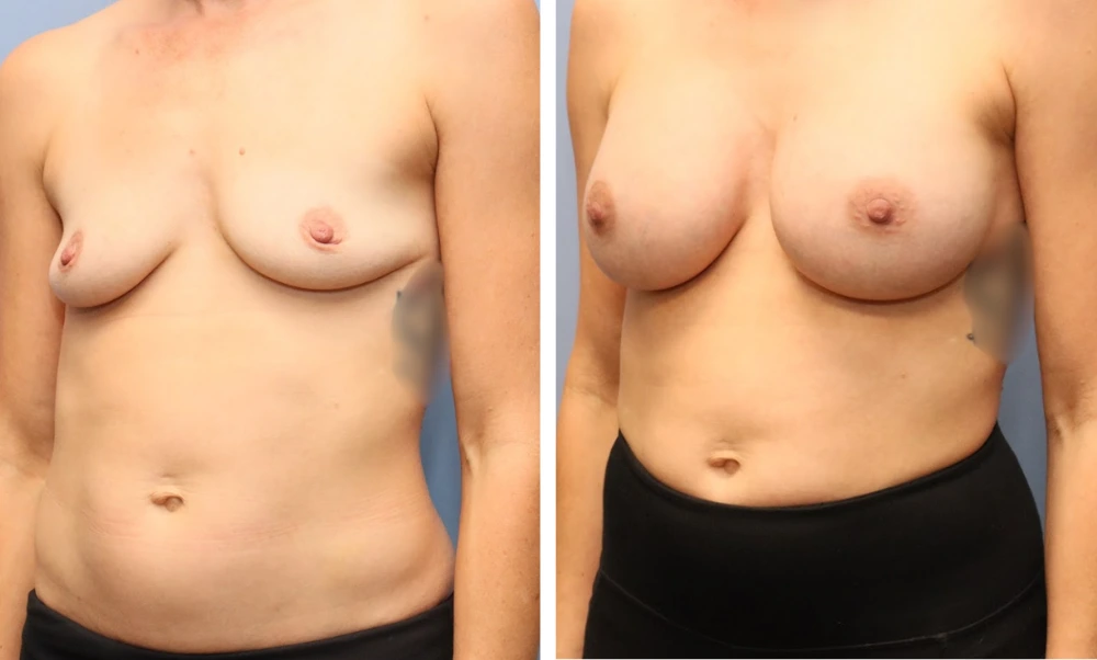 Case BAM-005 before and after breast augmentation, frontal view
