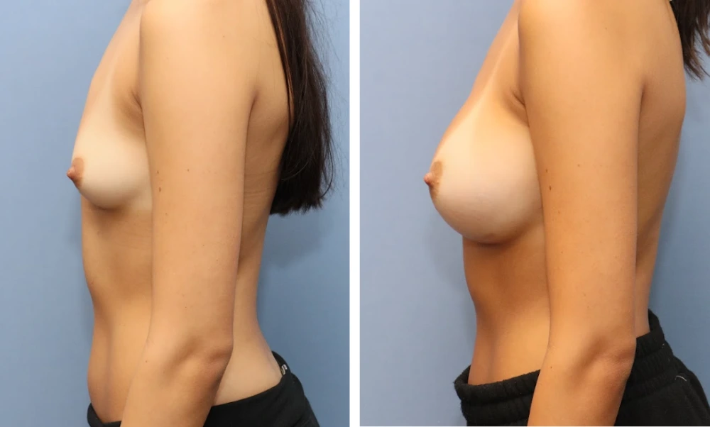 Case BAM-006 before and after breast augmentation, side view