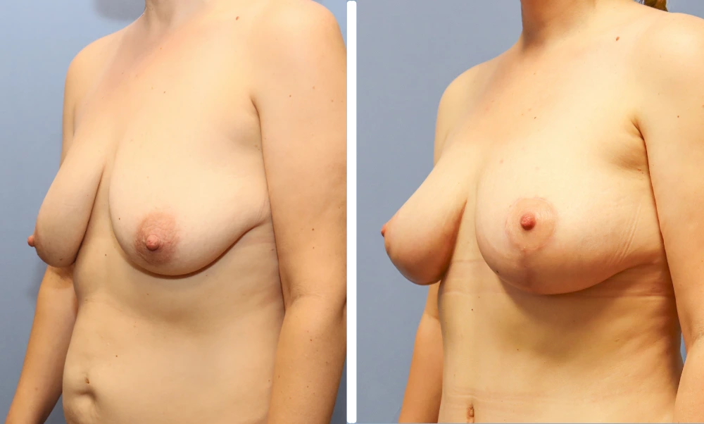 Before and after breast augmentation case showing angled side views