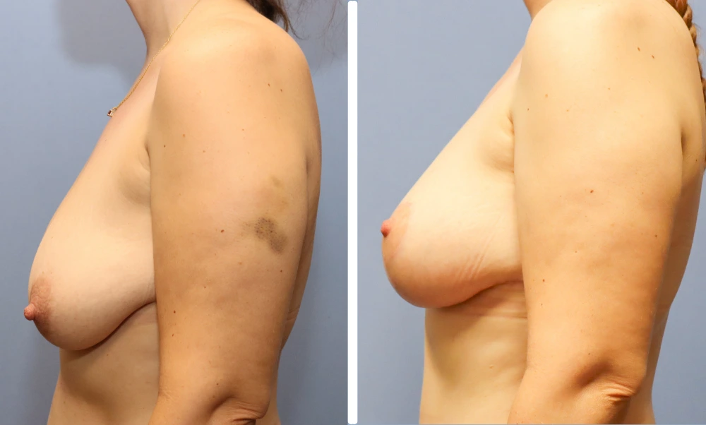 Before and after breast augmentation case showing side profile views