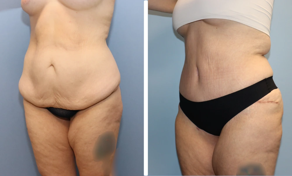 Before and after tummy tuck case showing front and angled torso views