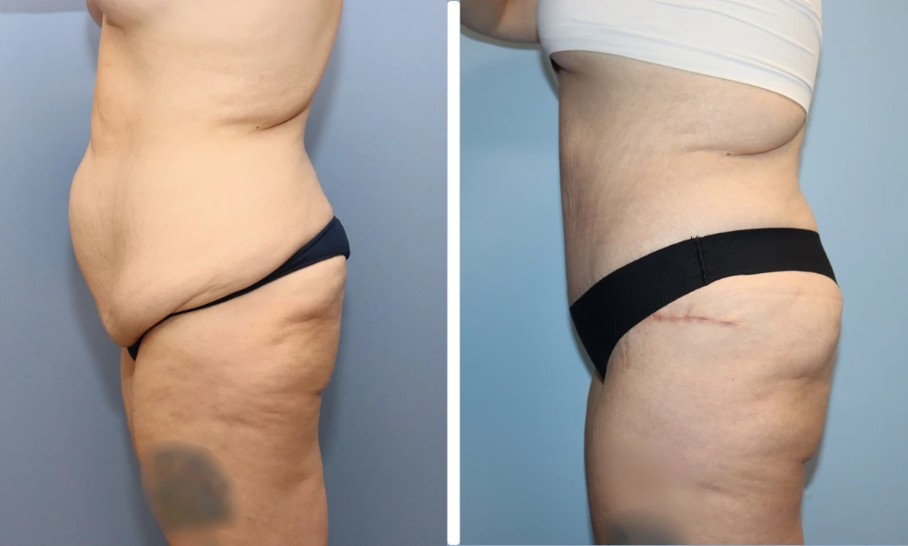 Before and after side views of abdomen and thighs showing reduced fullness and improved contour