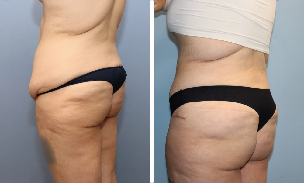 Before and after side views of abdomen and buttocks showing flattened midsection and enhanced shape