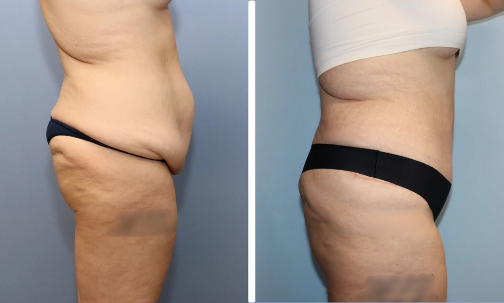 Before and after side views of lower torso and thighs displaying decreased sagging and smoother silhouette