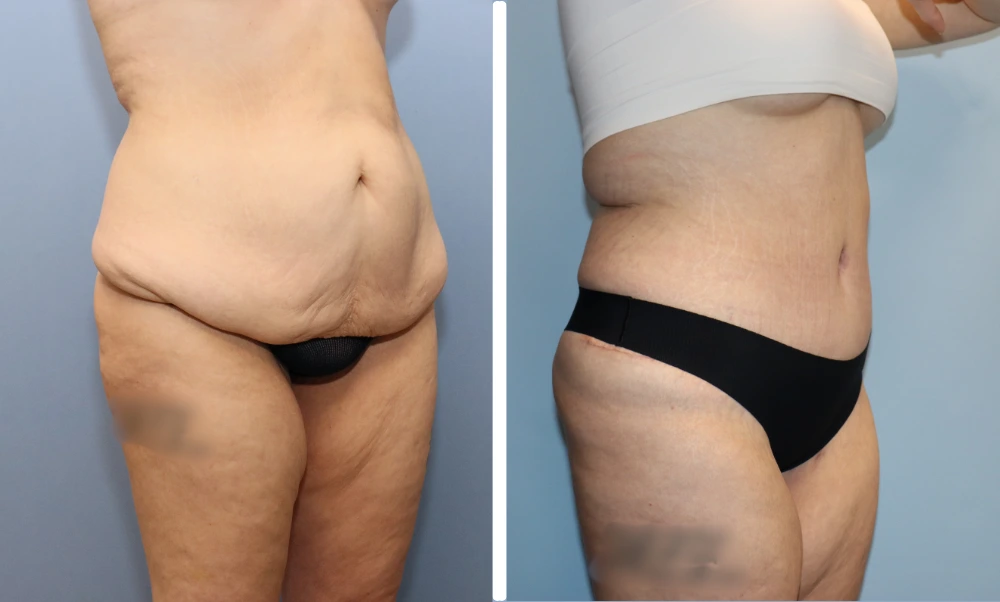 Before and after side views of lower abdomen and buttocks revealing tightened contours and lifted appearance