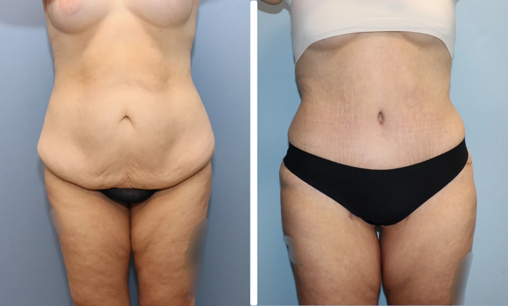 Before and after tummy tuck case showing front and side torso views