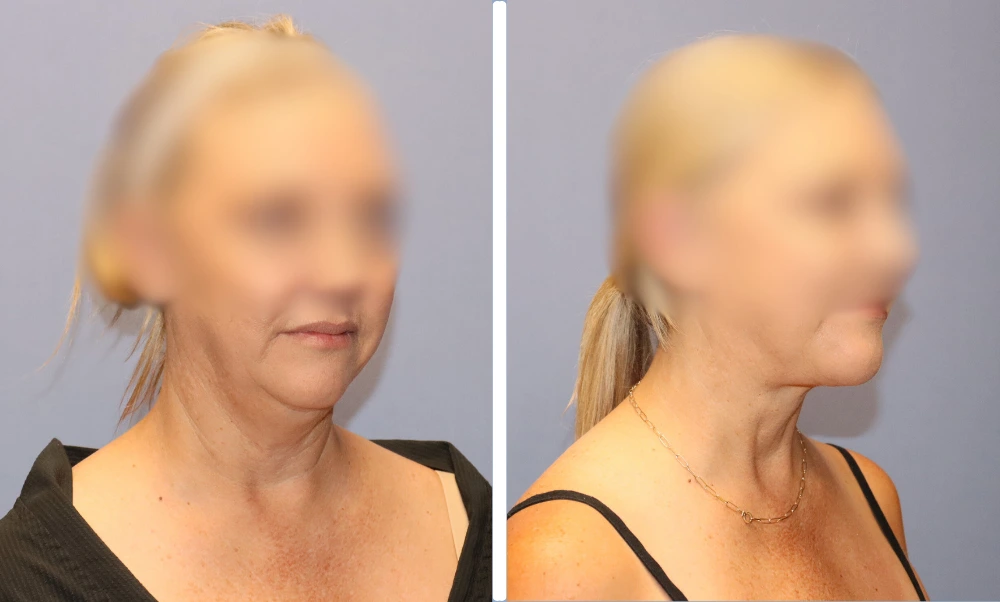 Neck-002 (1)