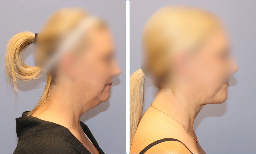 Neck-002 (2)