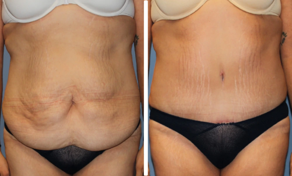 Before and after tummy tuck comparison showing abdominal contouring results