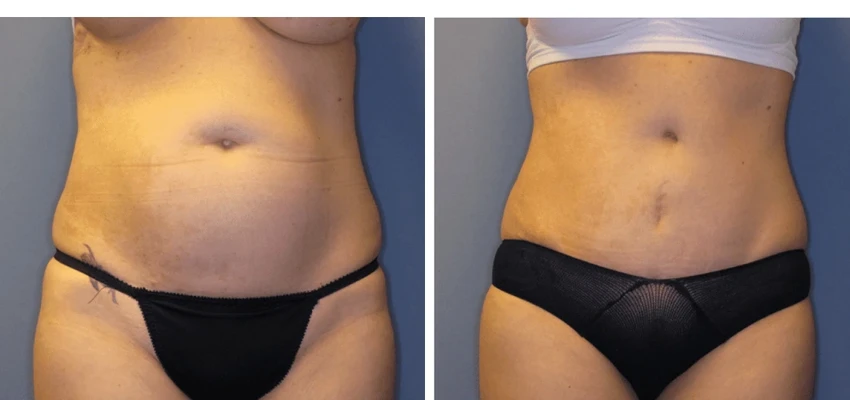 Before and after tummy tuck showing reduced abdominal fullness and flatter midsection