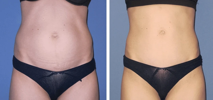 Before and after tummy tuck showing smoother, more contoured abdomen and improved waistline