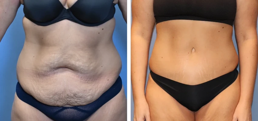 Before and after tummy tuck, showing abdomen with loose skin on left and tightened contour on right