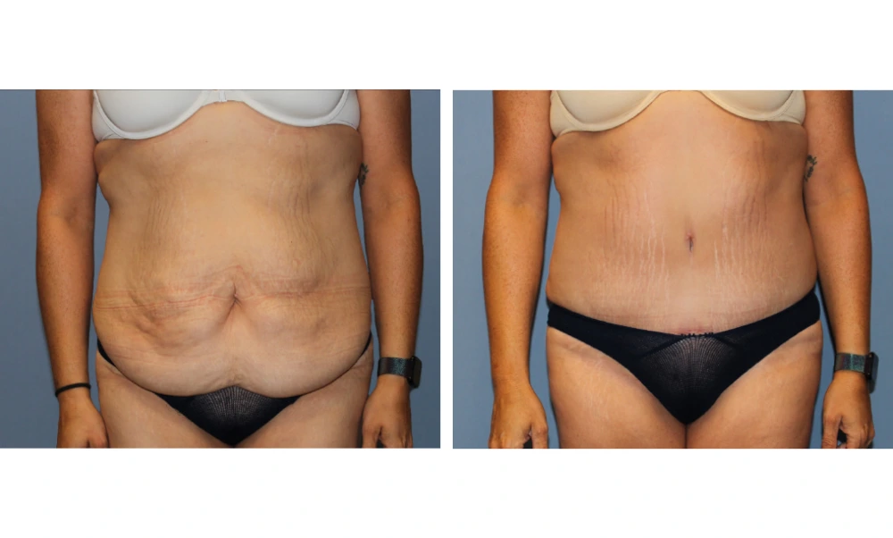 Before and after tummy tuck comparison showing abdominal contouring results