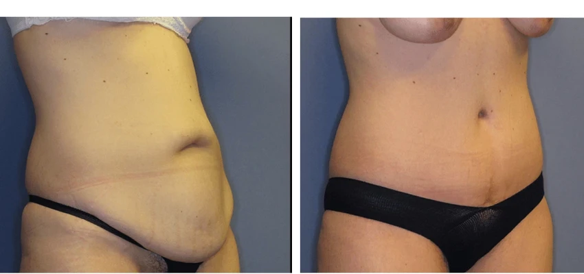 Before and after tummy tuck, showing protruding abdomen on left, defined flat abdomen on right