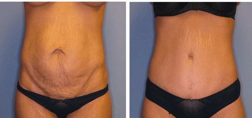 Before and after tummy tuck, showing loose abdominal skin and stretch marks on left, smooth contoured abdomen on right