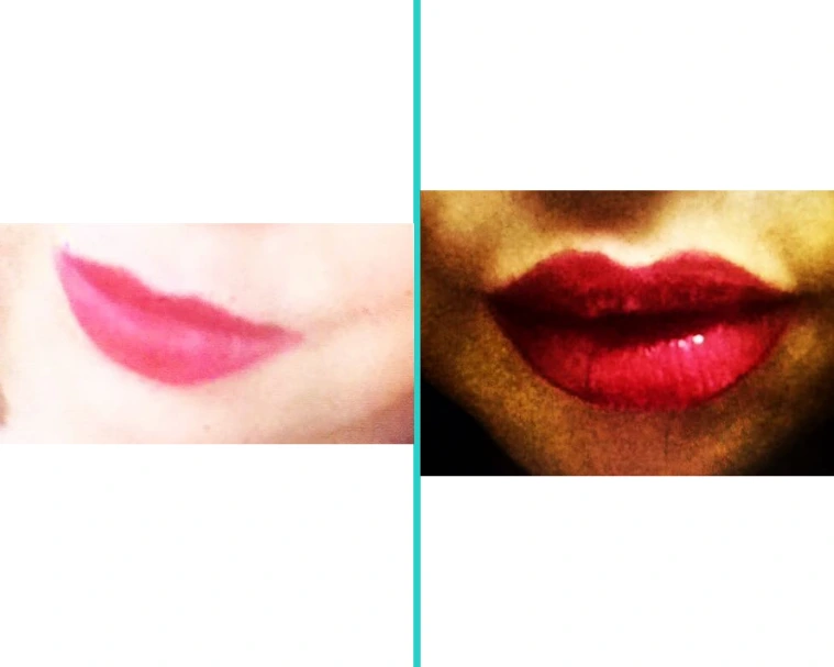 Before and after Restylane lip filler showing fuller, more defined lips with enhanced volume