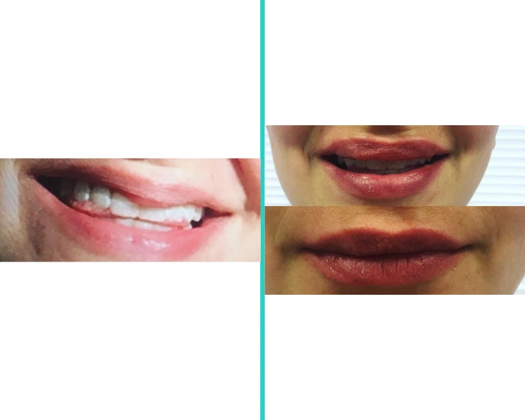Before and after lip filler results displaying increased lip fullness and improved lip definition