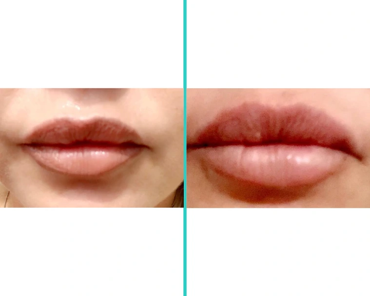 Before-and-after comparison of lip filler treatment showing fuller, more defined lips