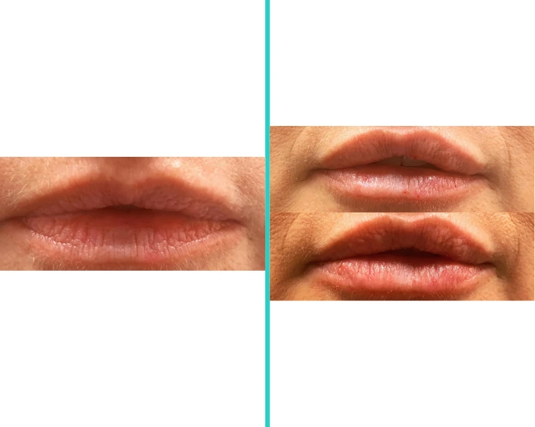 Before-and-after comparison of lip filler results on male patients showing increased volume