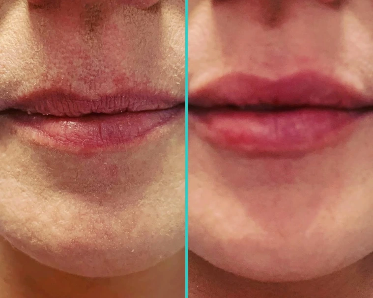 Before-and-after lip filler treatment demonstrating enhanced lip fullness and shape
