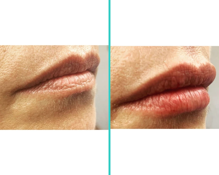 Before-and-after lip filler comparison showing improved lip volume and definition