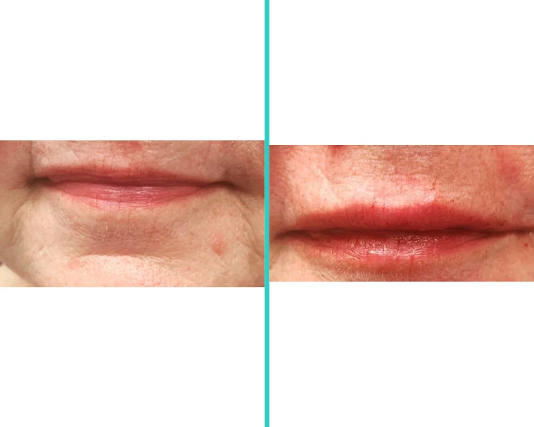 Before-and-after lip filler results displaying enhanced lip contour and plumpness