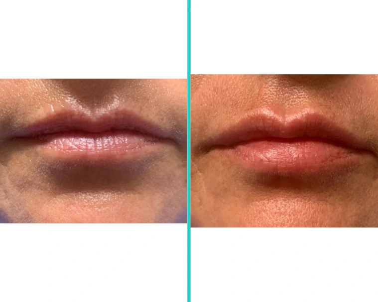 Before-and-after lip filler treatment on darker skin tone showing natural-looking enhancement