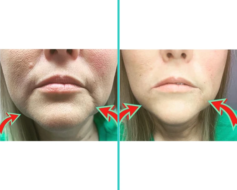 Before and after Juvederm filler treatment showing reduced lower face sagging and improved jawline definition