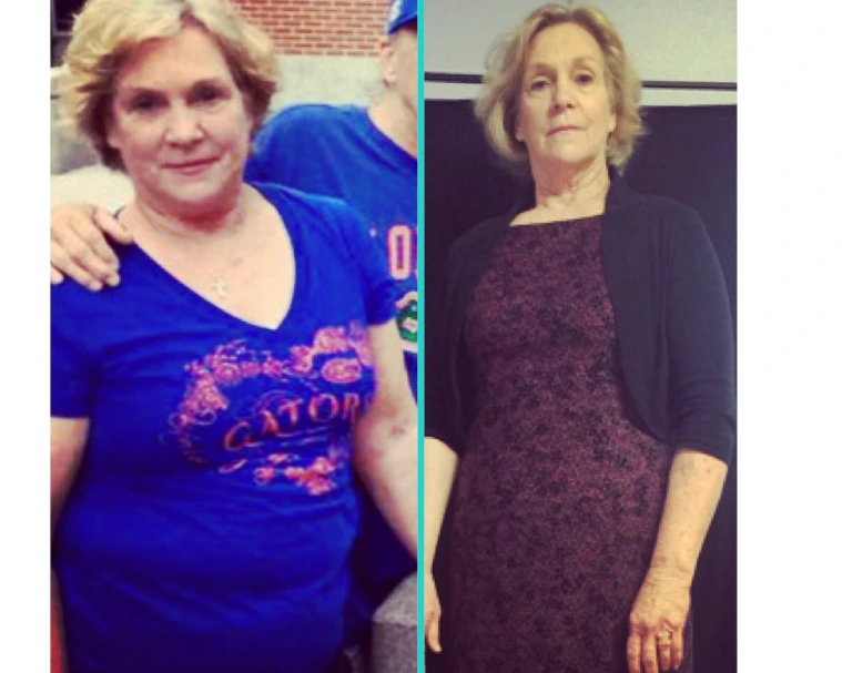 Before and after weight loss comparison showing woman in blue shirt and after in black top