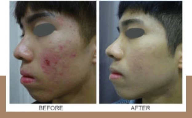 Acne Scar Banner