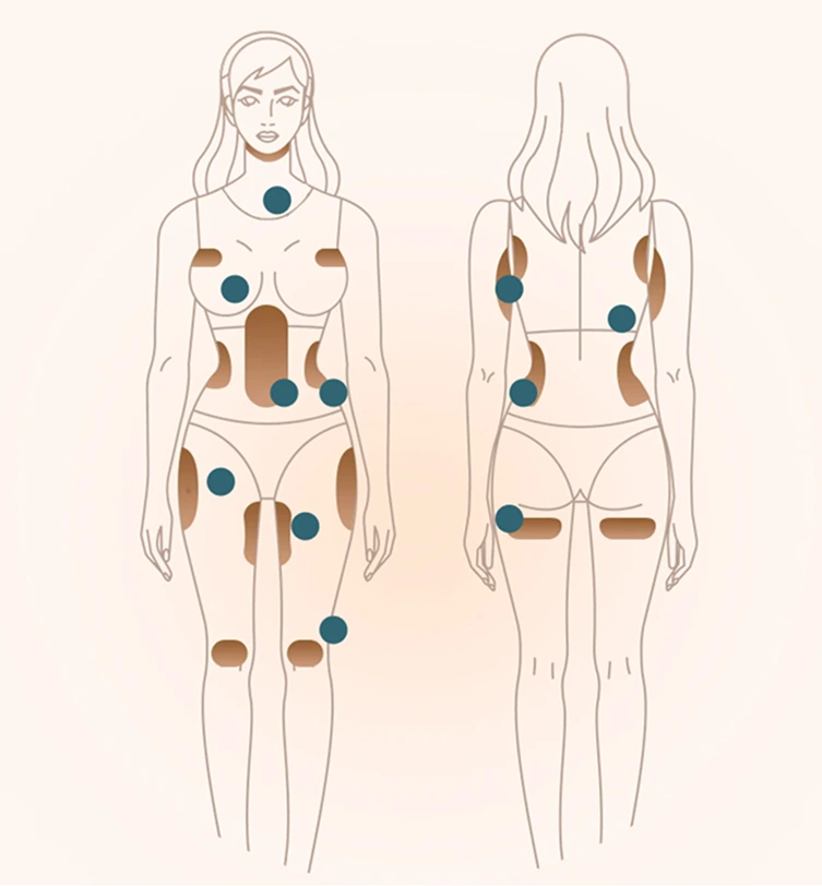 Diagram of female body front and back views with brown and teal dots marking common CoolSculpting treatment areas on abdomen, flanks, thighs, and back
