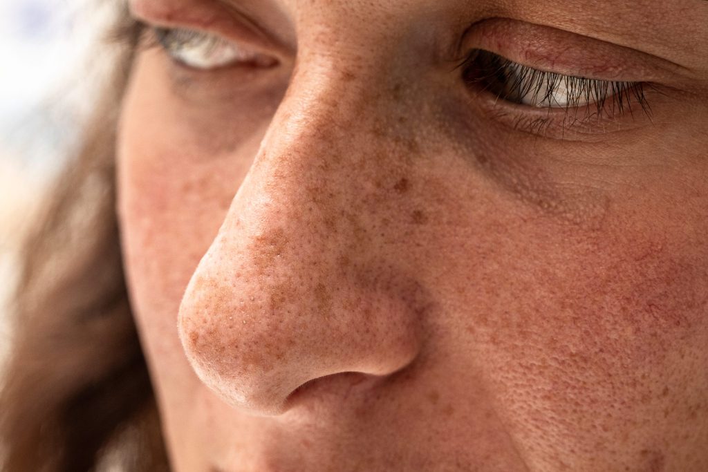 How to Get Rid of Sun Damage on Face Banner