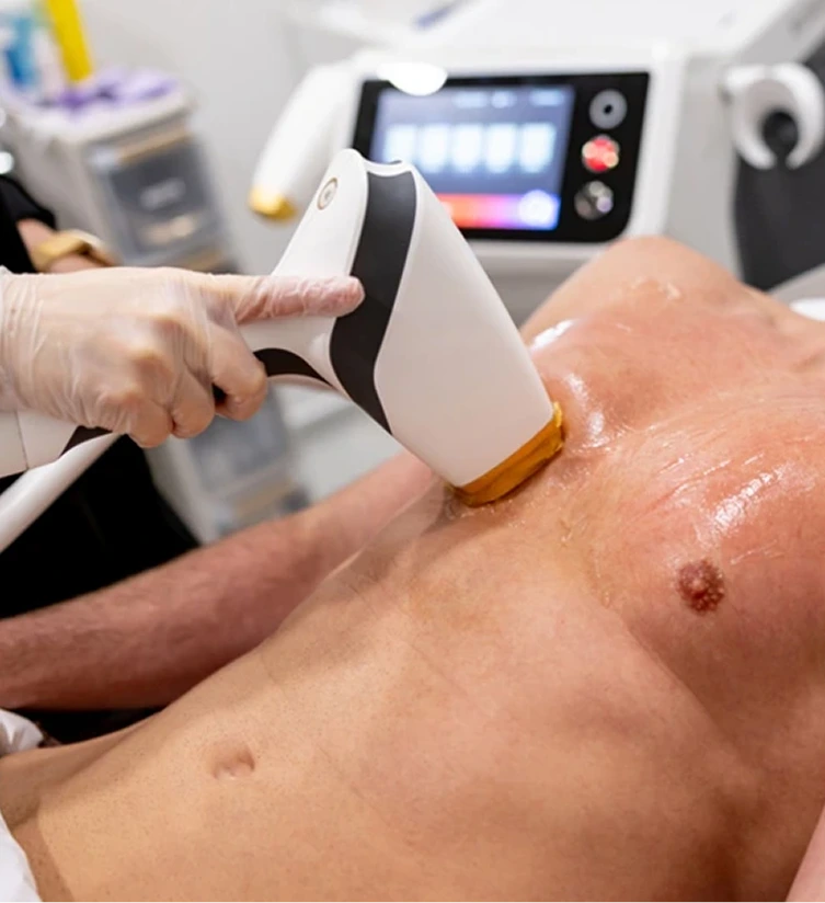Clinician using laser hair removal handpiece on patient's chest with control panel visible