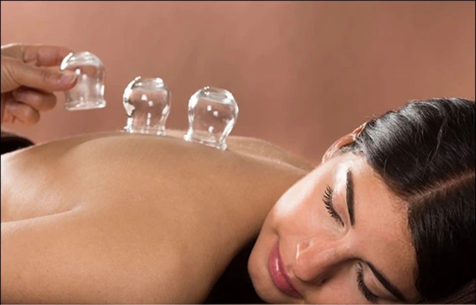Client receiving cupping therapy on back with glass cups during spa treatment