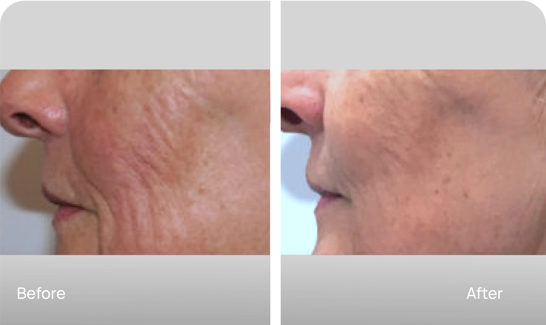 RF Microneedling - Case 3