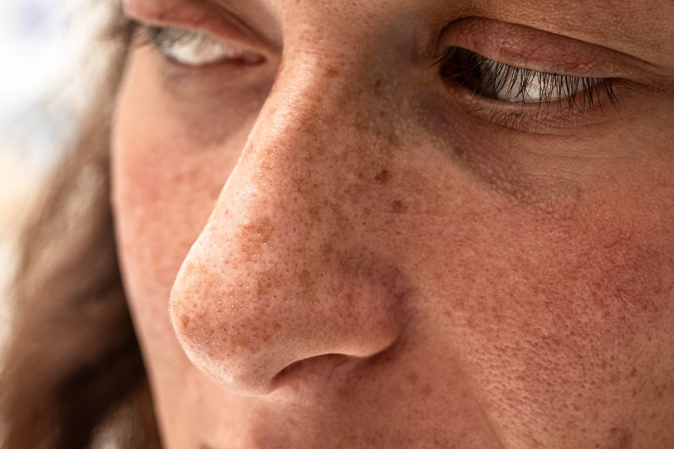 Closeup of woman's face showing freckles and complexion