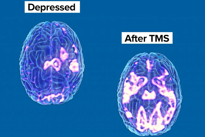 Brain scan comparison labeled Depressed and After TMS showing increased activity in treated brain