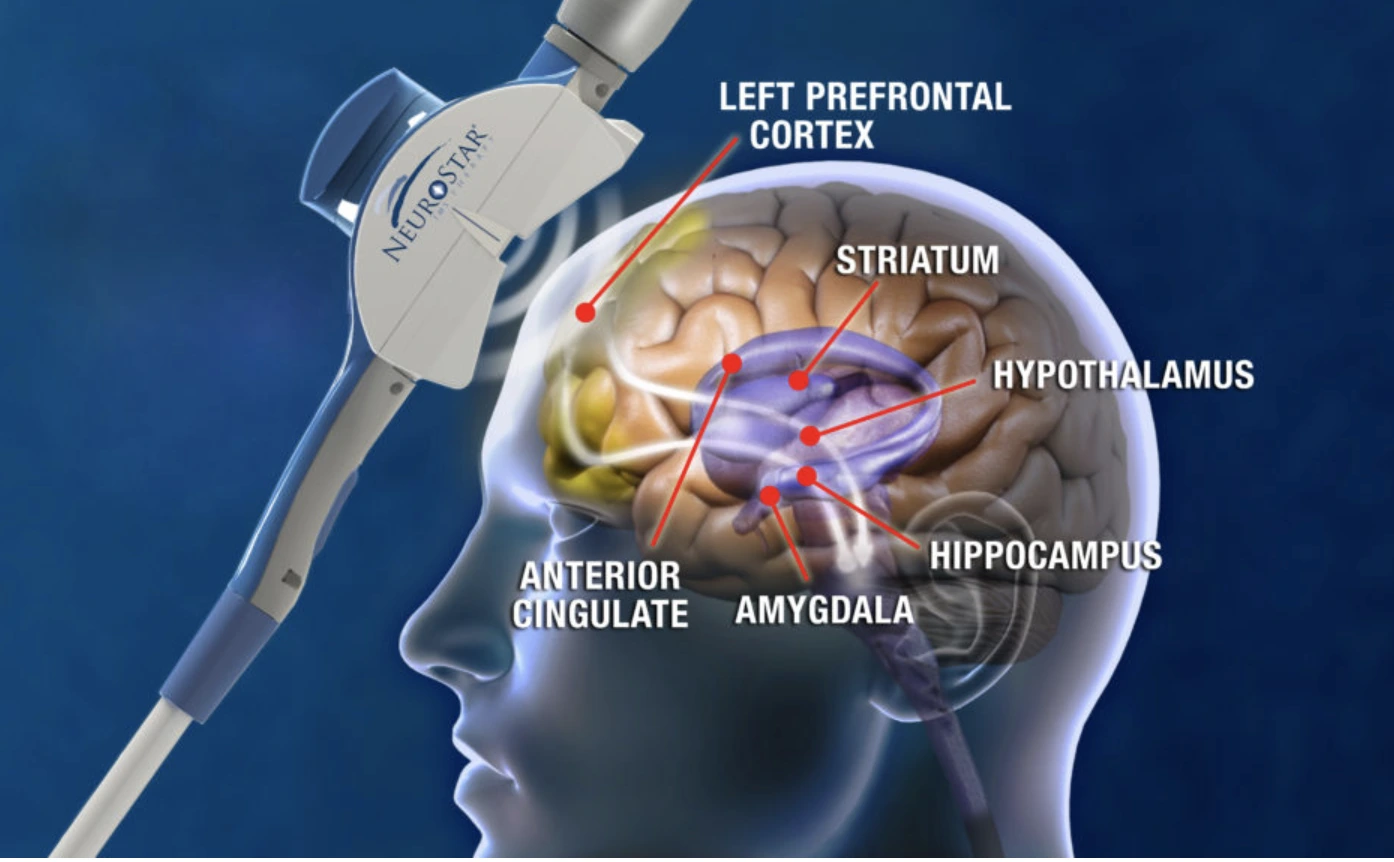TMS coil positioned above brain diagram showing left prefrontal cortex, striatum, hypothalamus, hippocampus, amygdala, and anterior cingulate