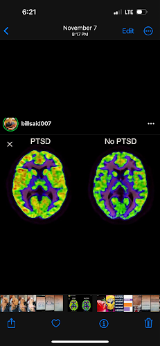 Brain scan comparison showing PTSD and no PTSD conditions with color-coded activity patterns